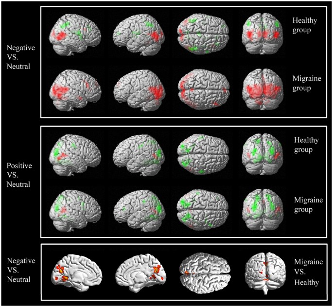 Migraine brain activity diagram
